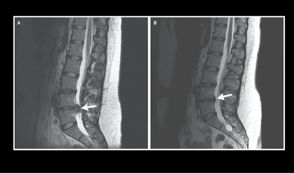 Resolution Of Lumbar Disc Herniation Without Surgery Dr Kevin Pauza