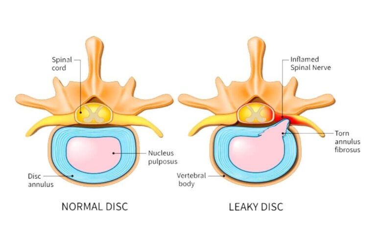 why-annular-tear-surgery-doesn-t-work-dr-kevin-pauza