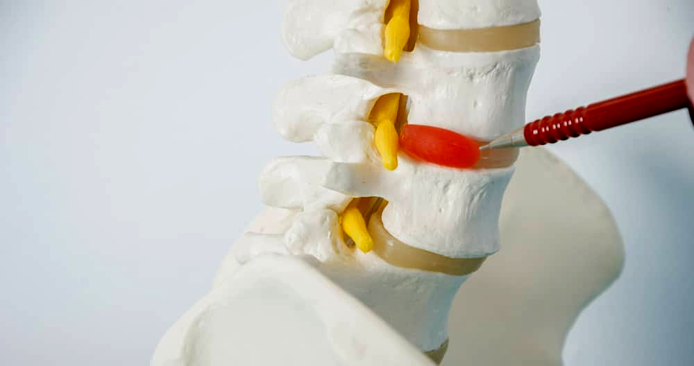 Muscle Relaxants for Herniated Disc Relief - Dr. Kevin Pauza