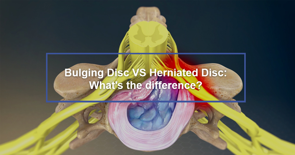 Bulging Disc VS Herniated Disc