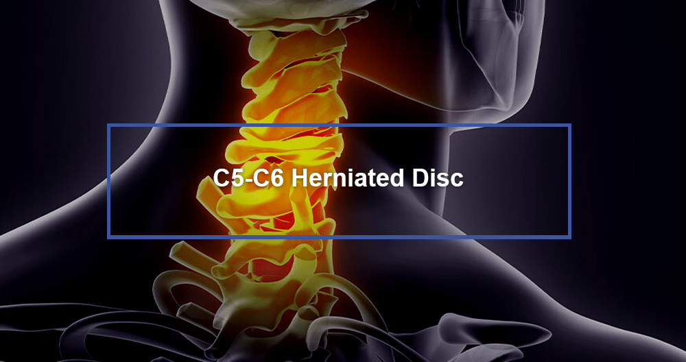 C5-C6 Herniated Disc - Dr. Kevin Pauza