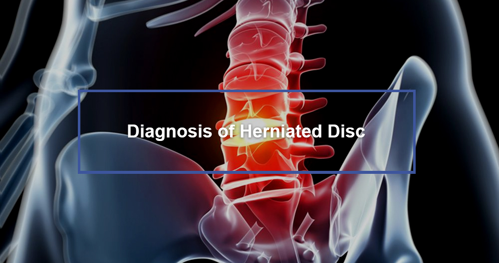 Diagnosis of Herniated Disc