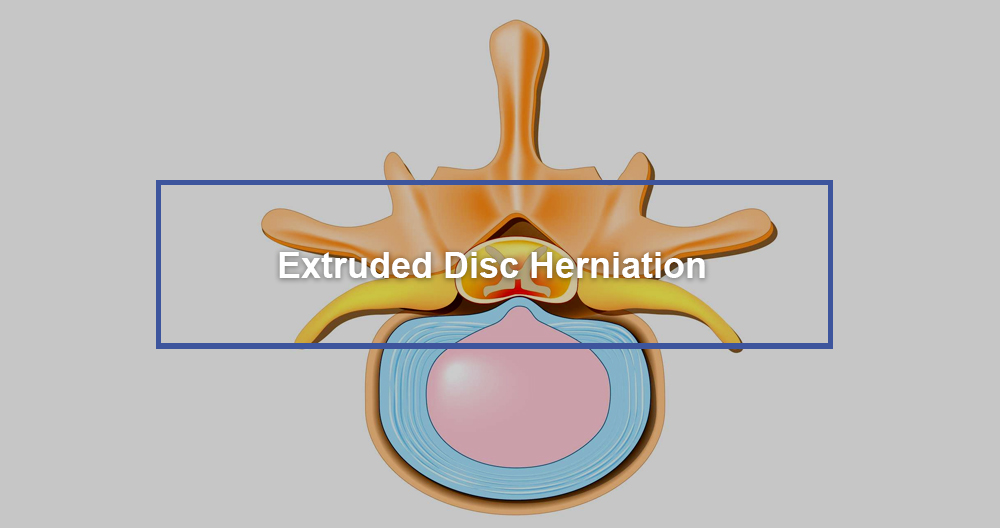 Extruded Disc Herniation
