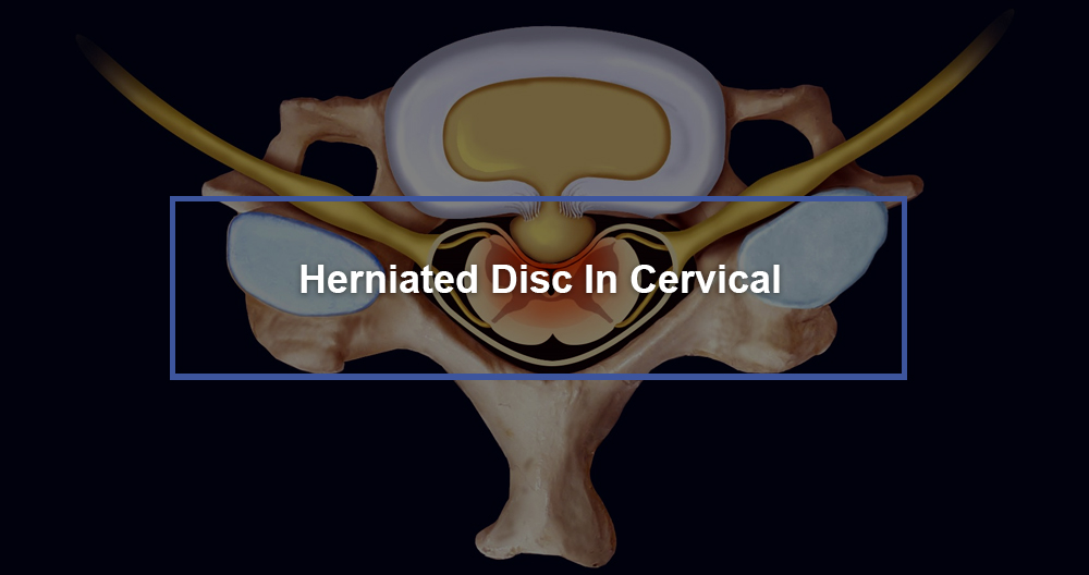 Cervical Herniated Disc 