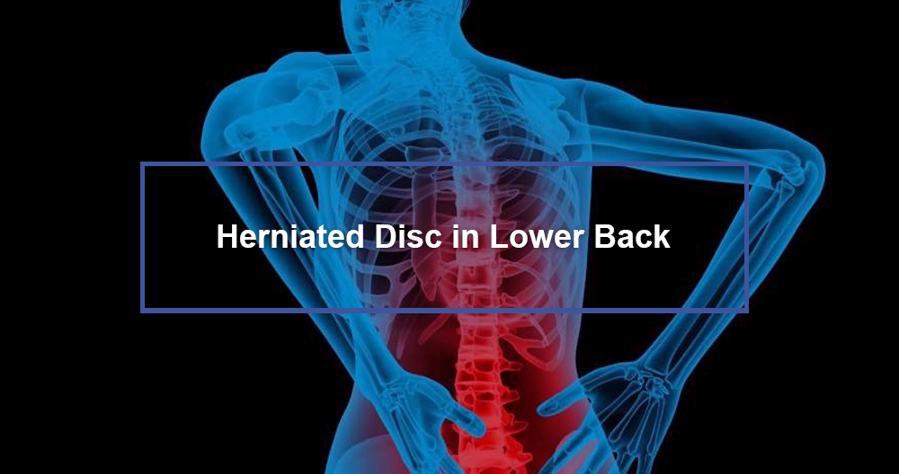 Lower Back Herniated Disc