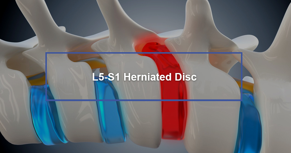 L5-S1 Herniated Disc