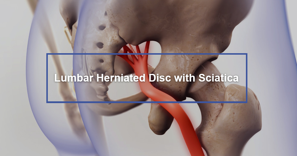 What is Lumbar Disc Herniation/Sciatica & How to Manage It? - Upswing Health