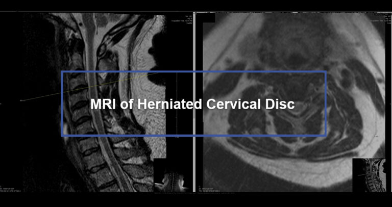 MRI of Herniated Cervical Disc - Dr. Kevin Pauza, The Discseel ...