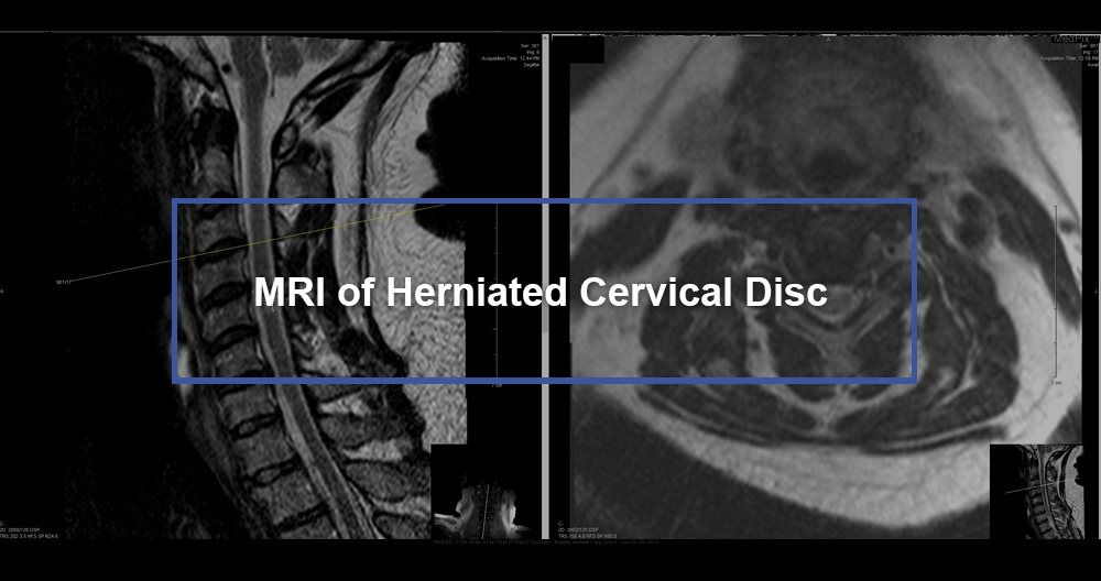 MRI of Herniated Cervical Disc