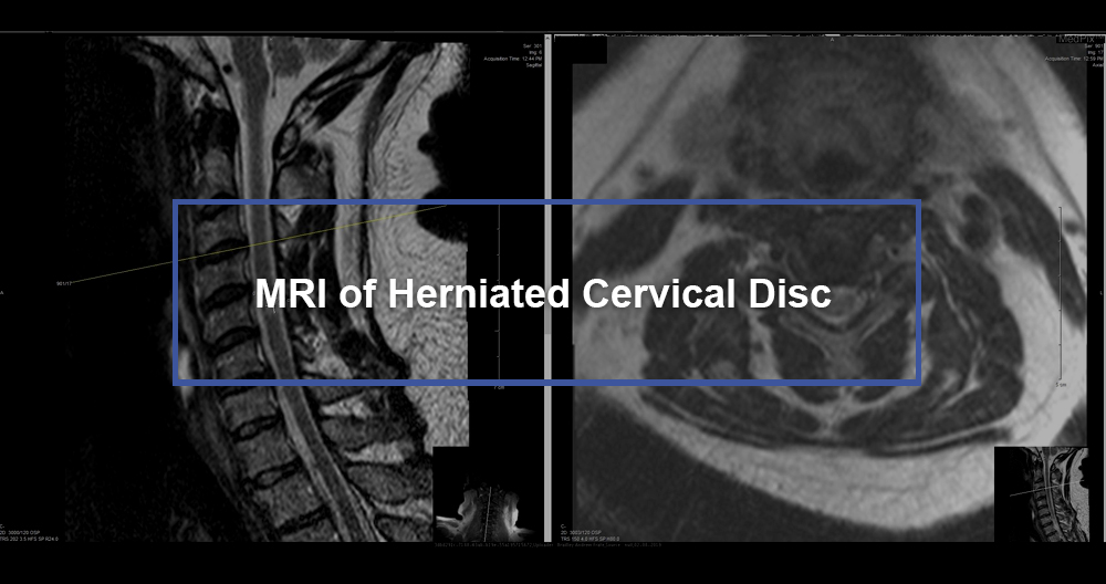 MRI of Herniated Cervical Disc 