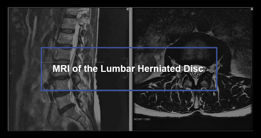 MRI of the Lumbar Herniated Disc
