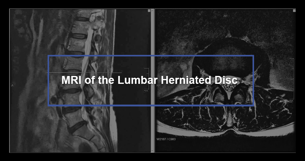 Healthcare Extreme How To Read An MRI Lumbar Spine In Easy 40 OFF