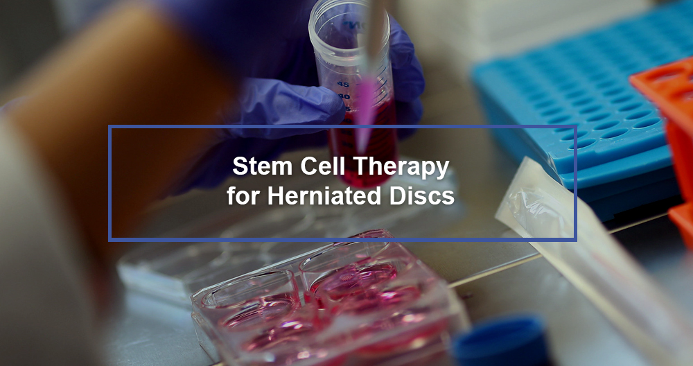 Stem Cell Therapy for Herniated Discs