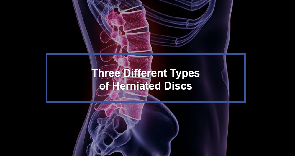 Types of Herniated Discs