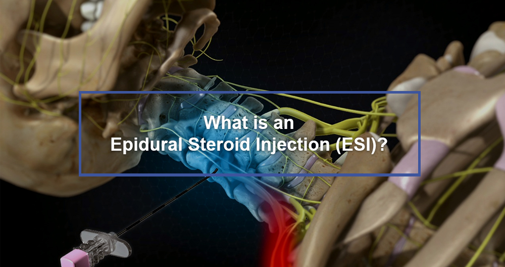 Epidural Steroid Injection (ESI)