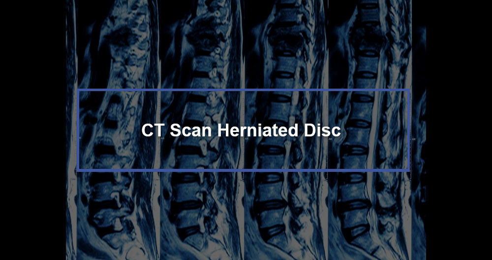 CT Scan Herniated Disc