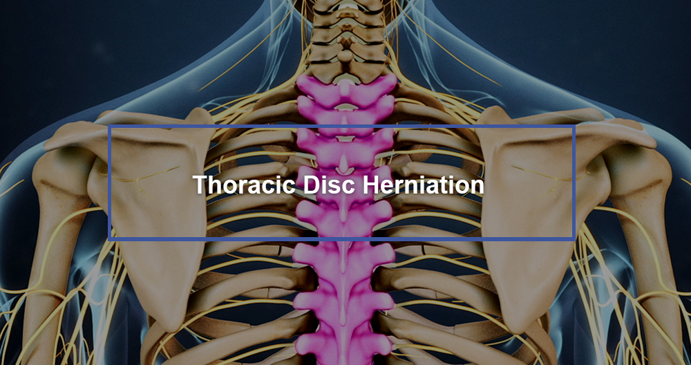 Thoracic Disc Herniation